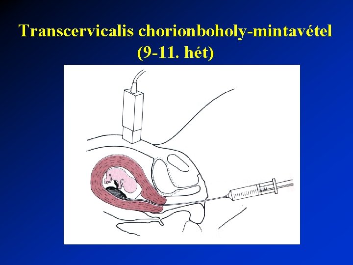 Transcervicalis chorionboholy-mintavétel (9 -11. hét) 