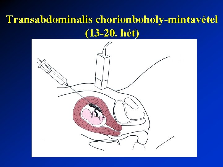 Transabdominalis chorionboholy-mintavétel (13 -20. hét) 