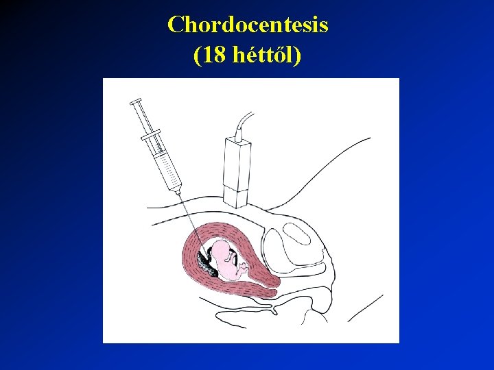 Chordocentesis (18 héttől) 