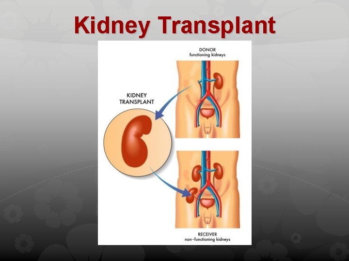 Kidney Transplant 