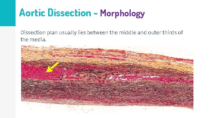 Aortic Dissection - Morphology Dissection plan usually lies between the middle and outer thirds