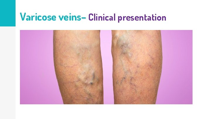 Varicose veins– Clinical presentation 