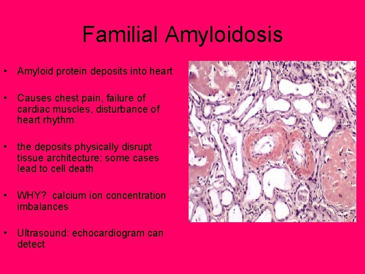 Familial Amyloidosis • Amyloid protein deposits into heart • Causes chest pain, failure of