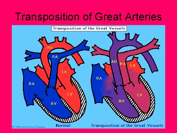 Transposition of Great Arteries 