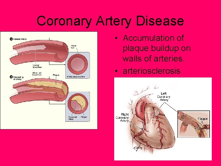 Coronary Artery Disease • Accumulation of plaque buildup on walls of arteries. • arteriosclerosis