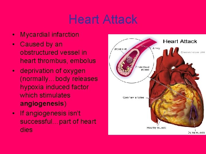 Heart Attack • Mycardial infarction • Caused by an obstructured vessel in heart thrombus,