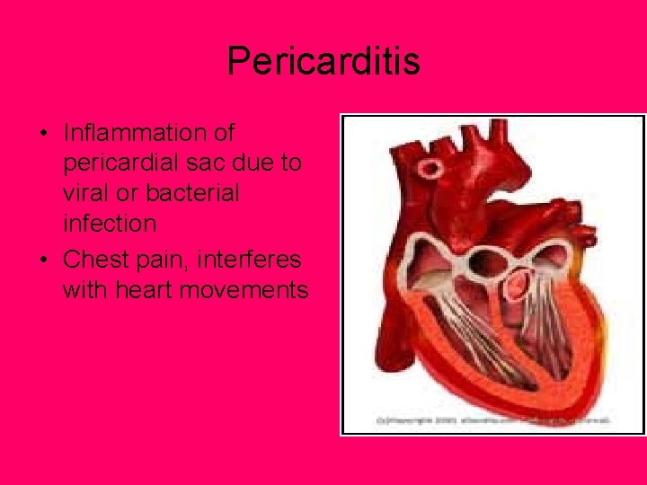 Pericarditis • Inflammation of pericardial sac due to viral or bacterial infection • Chest