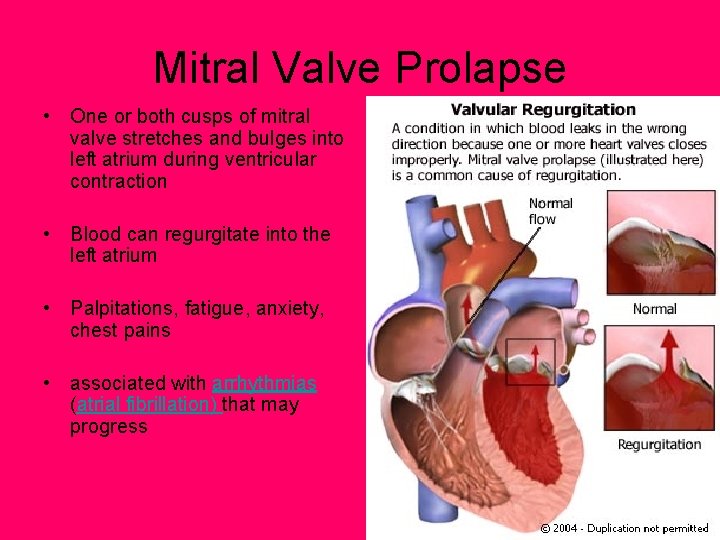 Mitral Valve Prolapse • One or both cusps of mitral valve stretches and bulges