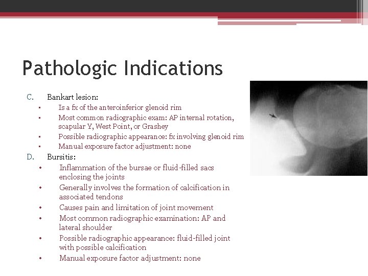 Pathologic Indications C. Bankart lesion: • • D. • • • Is a fx