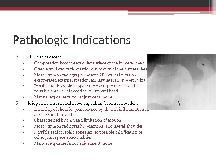 Pathologic Indications E. Hill-Sachs defect • • • F. Compression fx of the articular