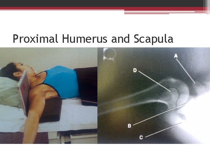 Proximal Humerus and Scapula 