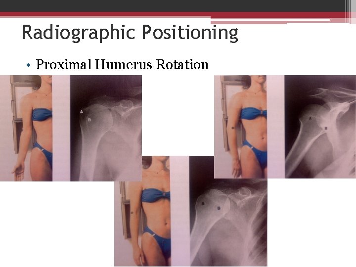 Radiographic Positioning • Proximal Humerus Rotation 