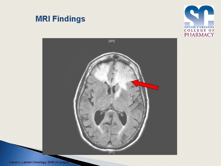 MRI Findings Carson, Lancet Oncology 2009 (In press) 