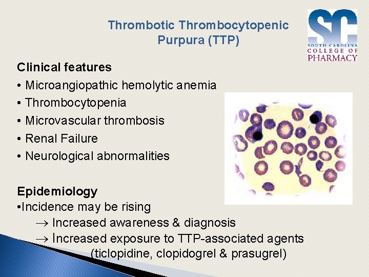 Thrombotic Thrombocytopenic Purpura (TTP) Clinical features • Microangiopathic hemolytic anemia • Thrombocytopenia • Microvascular