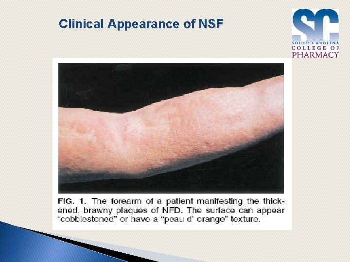 Clinical Appearance of NSF 