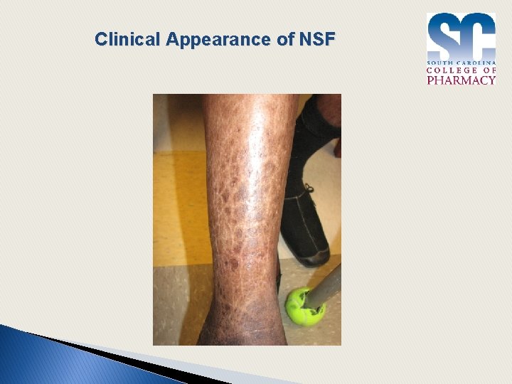 Clinical Appearance of NSF 