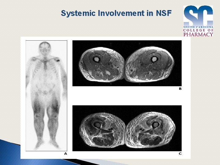 Systemic Involvement in NSF 