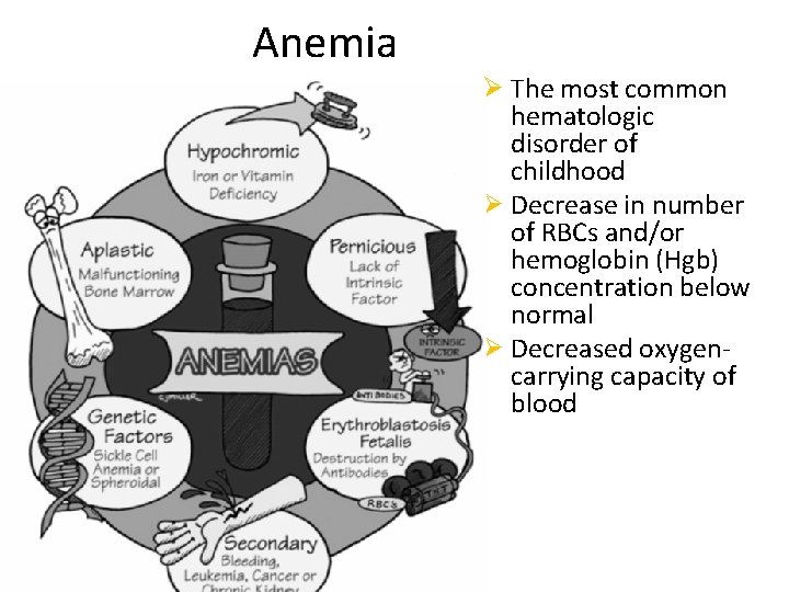 Anemia Ø The most common hematologic disorder of childhood Ø Decrease in number of