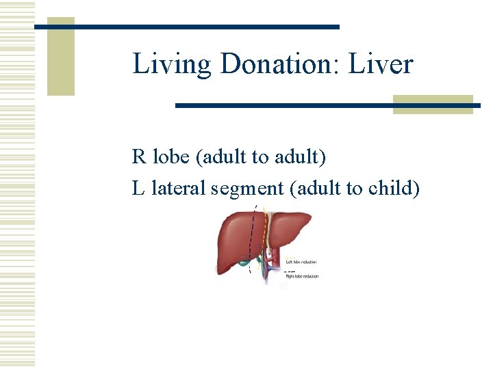 Living Donation: Liver R lobe (adult to adult) L lateral segment (adult to child)