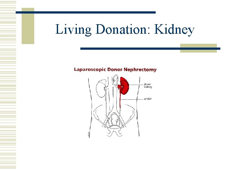 Living Donation: Kidney 