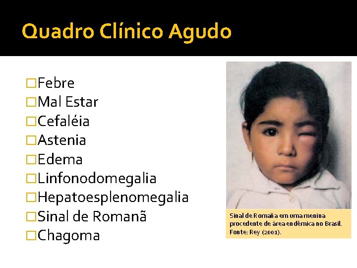 Quadro Clínico Agudo �Febre �Mal Estar �Cefaléia �Astenia �Edema �Linfonodomegalia �Hepatoesplenomegalia �Sinal de Romanã