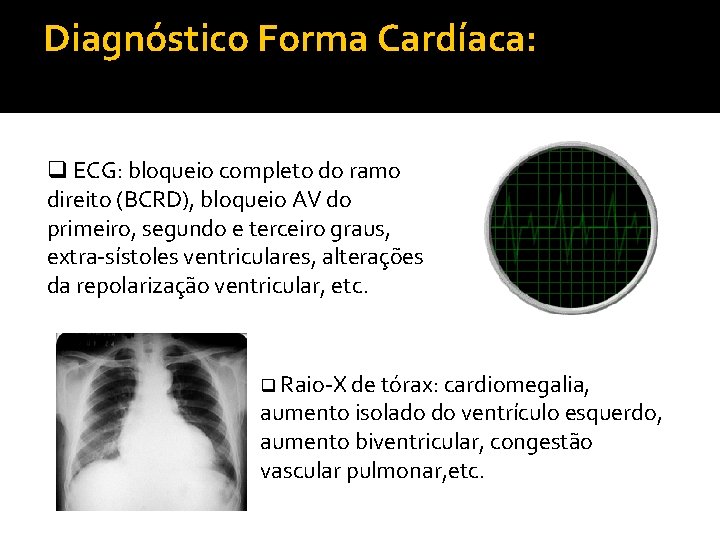 Diagnóstico Forma Cardíaca: q ECG: bloqueio completo do ramo direito (BCRD), bloqueio AV do