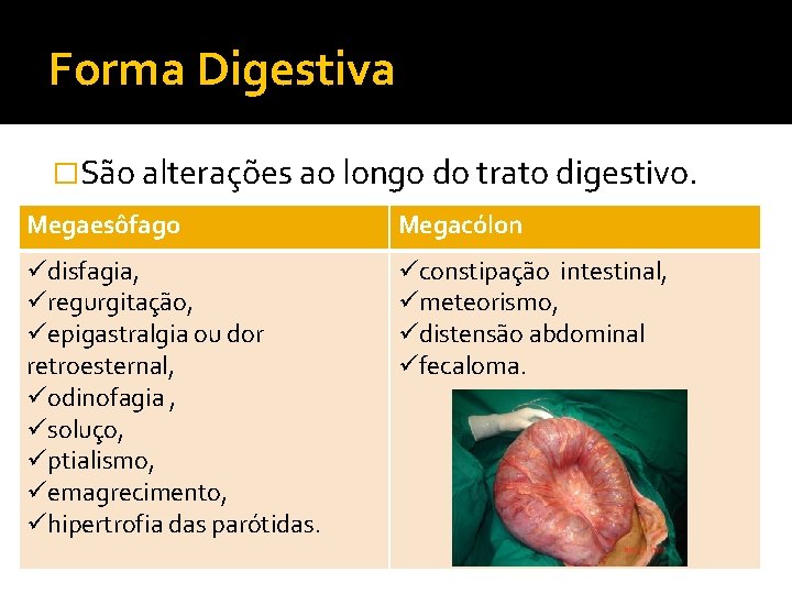 Forma Digestiva �São alterações ao longo do trato digestivo. Megaesôfago Megacólon üdisfagia, üregurgitação, üepigastralgia