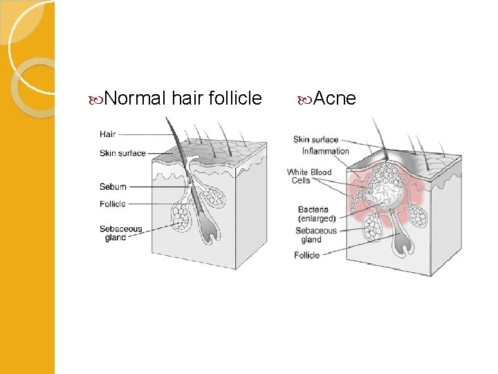  Normal hair follicle Acne 