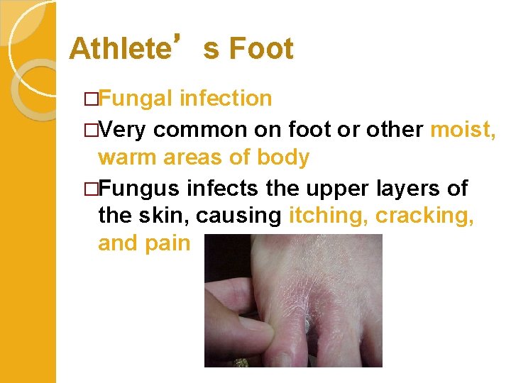 Athlete’s Foot �Fungal infection �Very common on foot or other moist, warm areas of