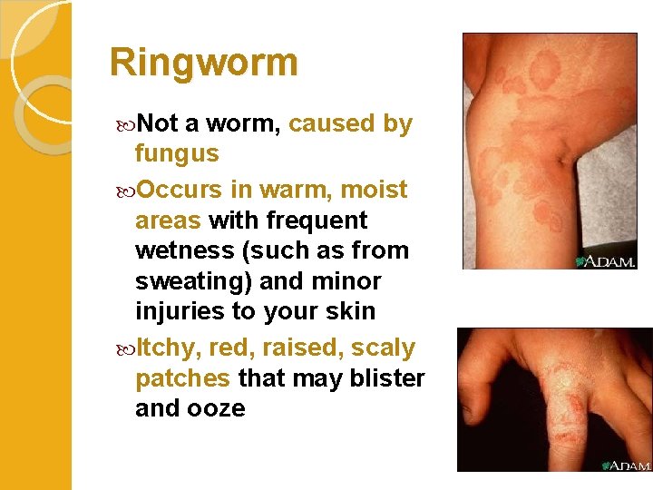 Ringworm Not a worm, caused by fungus Occurs in warm, moist areas with frequent