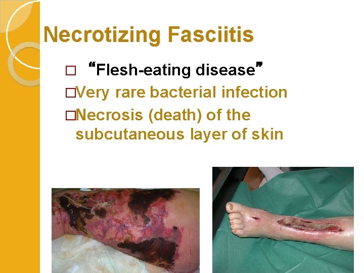 Necrotizing Fasciitis disease” �Very rare bacterial infection �Necrosis (death) of the subcutaneous layer of