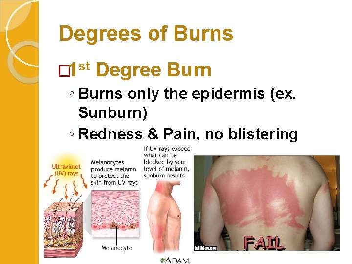 Degrees of Burns � 1 st Degree Burn ◦ Burns only the epidermis (ex.