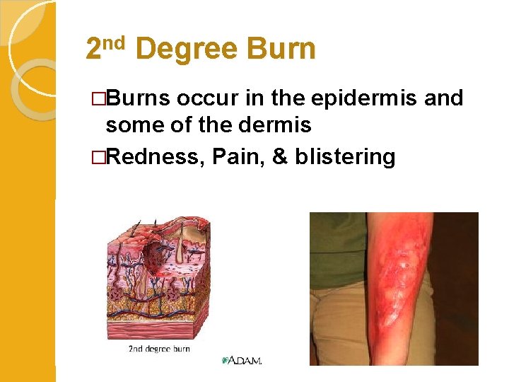 2 nd Degree Burn �Burns occur in the epidermis and some of the dermis