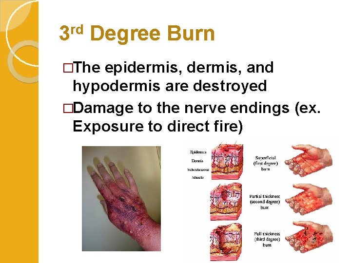 3 rd Degree Burn �The epidermis, and hypodermis are destroyed �Damage to the nerve