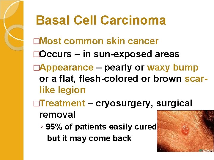Basal Cell Carcinoma �Most common skin cancer �Occurs – in sun-exposed areas �Appearance –