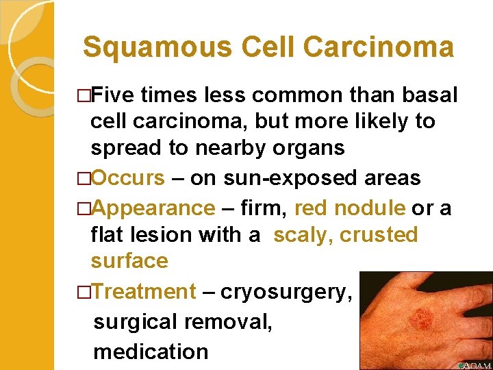 Squamous Cell Carcinoma �Five times less common than basal cell carcinoma, but more likely