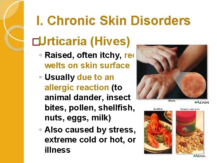I. Chronic Skin Disorders �Urticaria (Hives) ◦ Raised, often itchy, red welts on skin