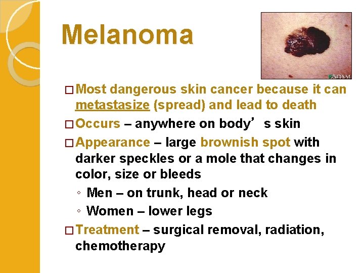 Melanoma � Most dangerous skin cancer because it can metastasize (spread) and lead to