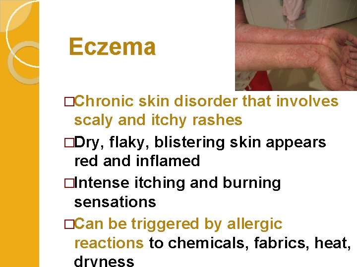 Eczema �Chronic skin disorder that involves scaly and itchy rashes �Dry, flaky, blistering skin