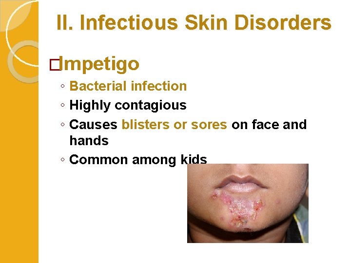 II. Infectious Skin Disorders �Impetigo ◦ Bacterial infection ◦ Highly contagious ◦ Causes blisters
