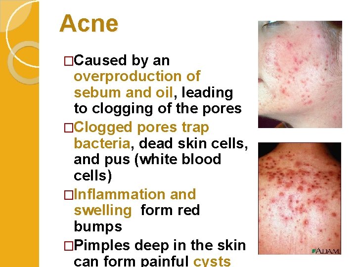 Acne �Caused by an overproduction of sebum and oil, leading to clogging of the