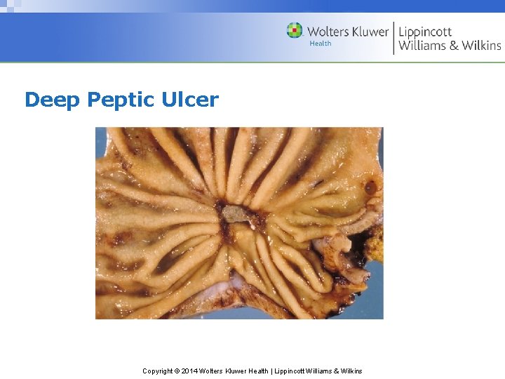 Deep Peptic Ulcer Copyright © 2014 Wolters Kluwer Health | Lippincott Williams & Wilkins