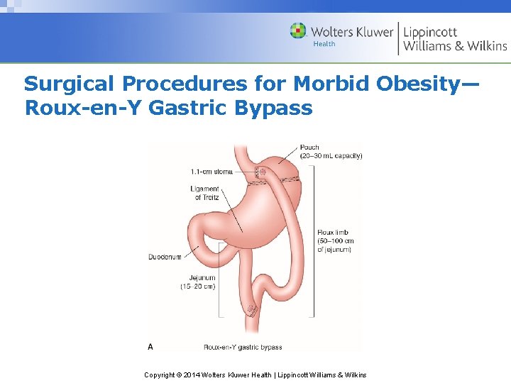 Surgical Procedures for Morbid Obesity— Roux-en-Y Gastric Bypass Copyright © 2014 Wolters Kluwer Health