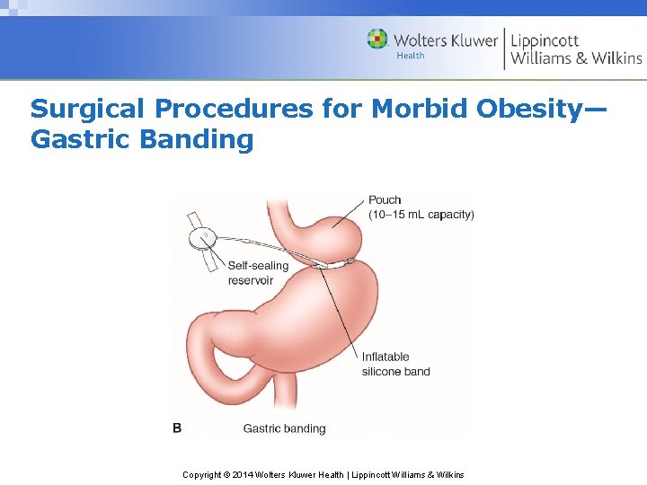 Surgical Procedures for Morbid Obesity— Gastric Banding Copyright © 2014 Wolters Kluwer Health |