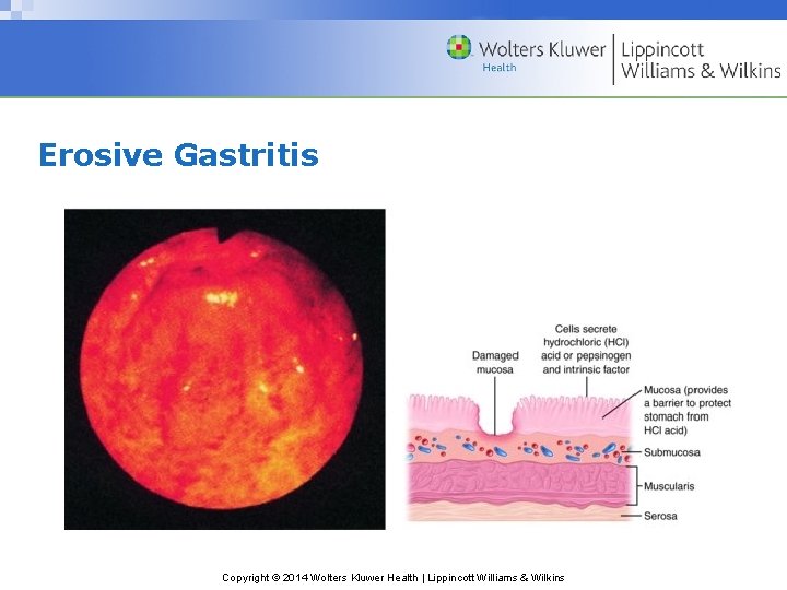 Erosive Gastritis Copyright © 2014 Wolters Kluwer Health | Lippincott Williams & Wilkins 