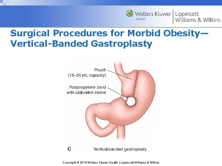 Surgical Procedures for Morbid Obesity— Vertical-Banded Gastroplasty Copyright © 2014 Wolters Kluwer Health |