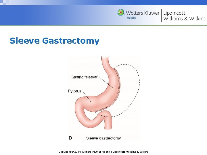 Sleeve Gastrectomy Copyright © 2014 Wolters Kluwer Health | Lippincott Williams & Wilkins 