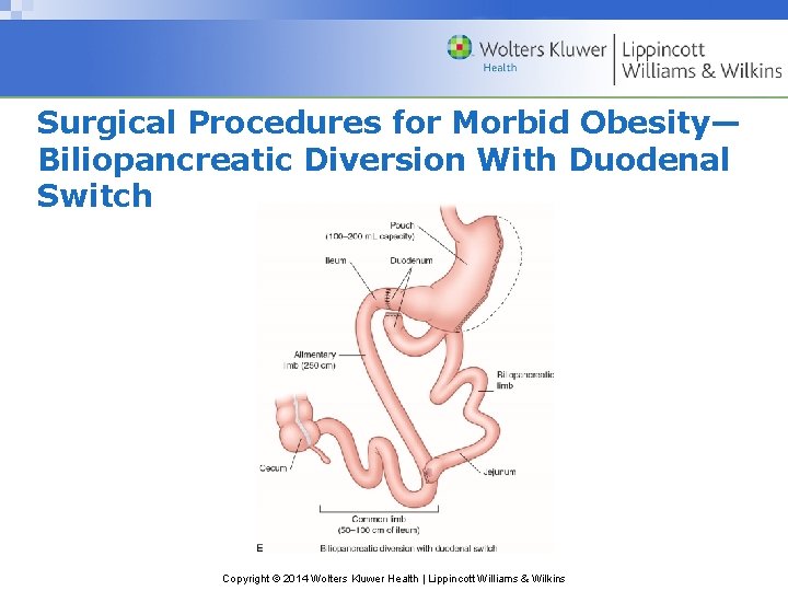 Surgical Procedures for Morbid Obesity— Biliopancreatic Diversion With Duodenal Switch Copyright © 2014 Wolters