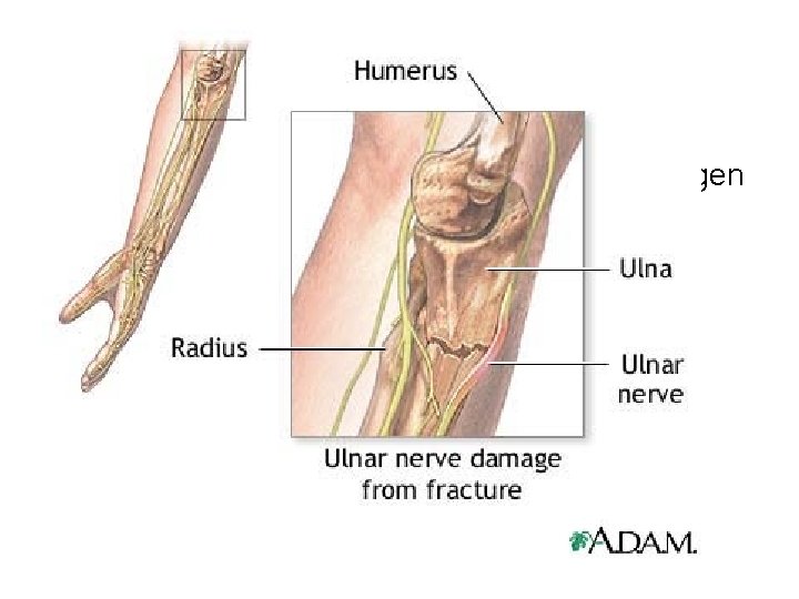 Ulnar nerve injury Causes : General causes : metabolic diseases , collagen diseases ,