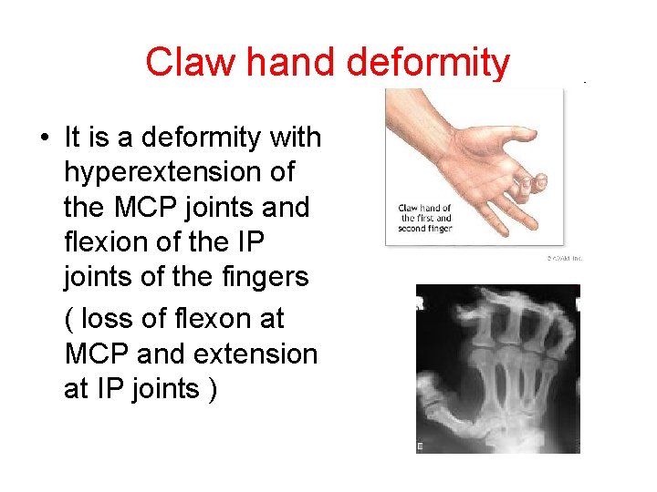 Claw hand deformity • It is a deformity with hyperextension of the MCP joints